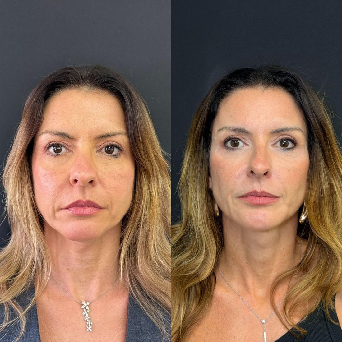 Antes e depois de harmonização de rosto inteiro