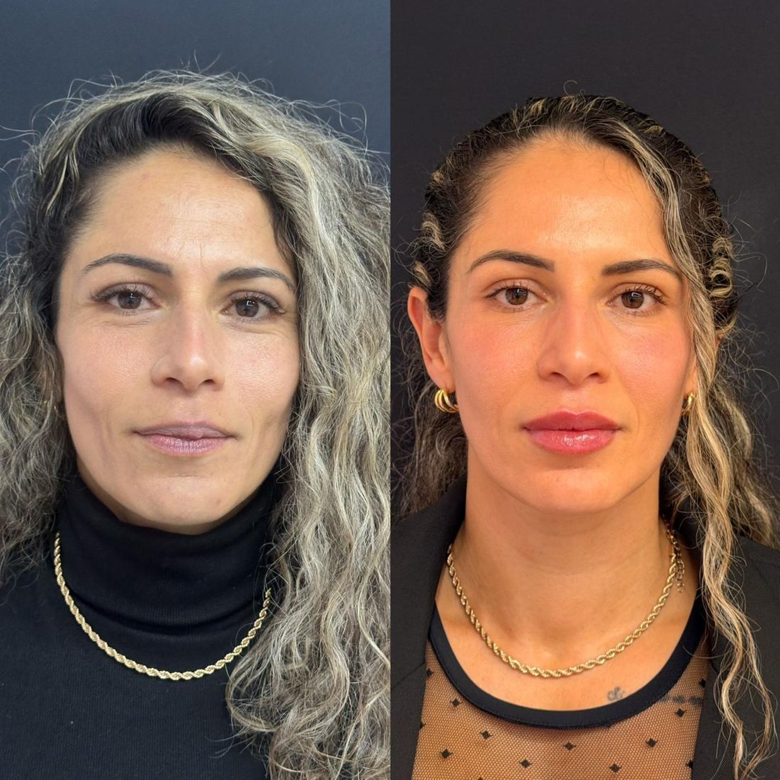 Antes e depois de bioestimulador de colágeno