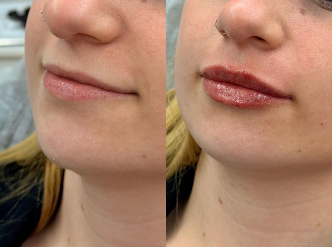 Antes e depois de preenchimento labial