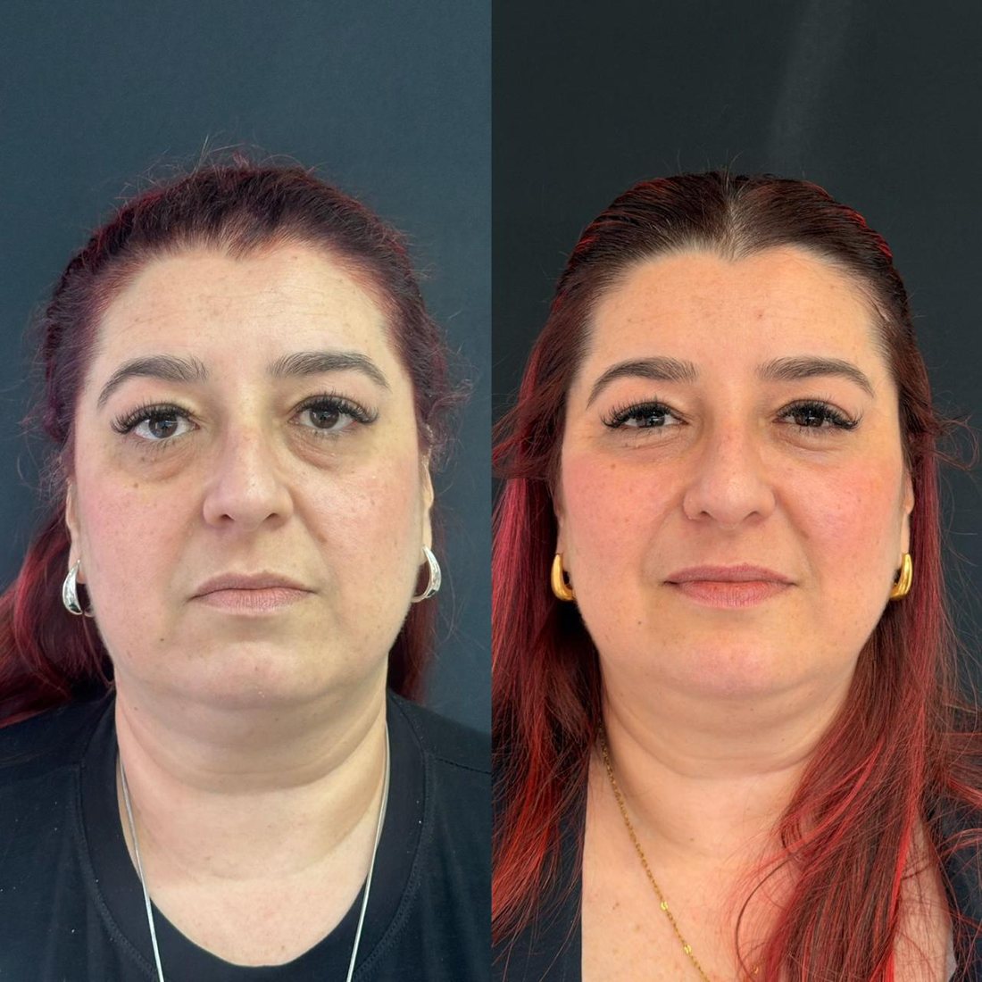 Antes e depois de tratamento de olheiras
