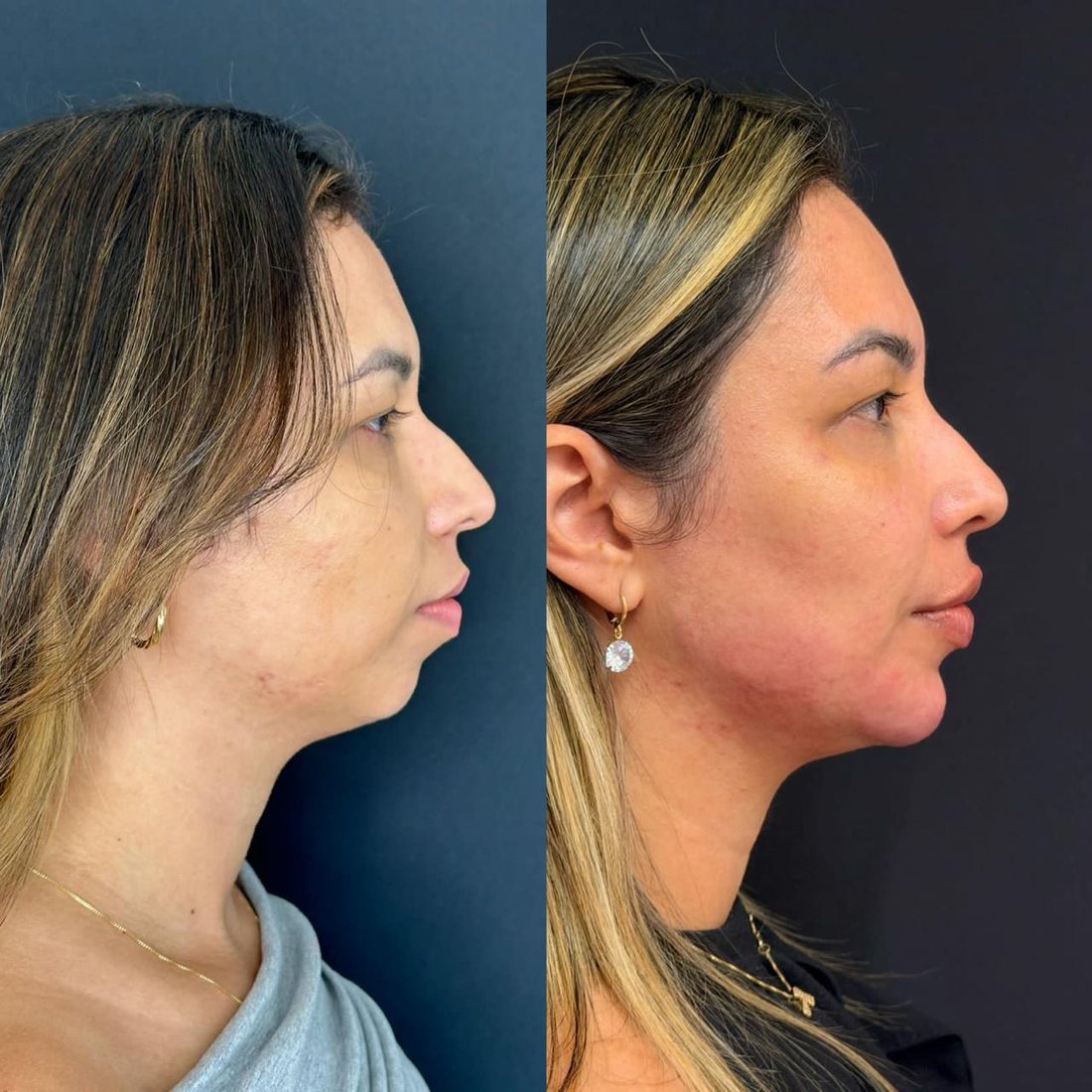 Antes e depois de tratamento de papada