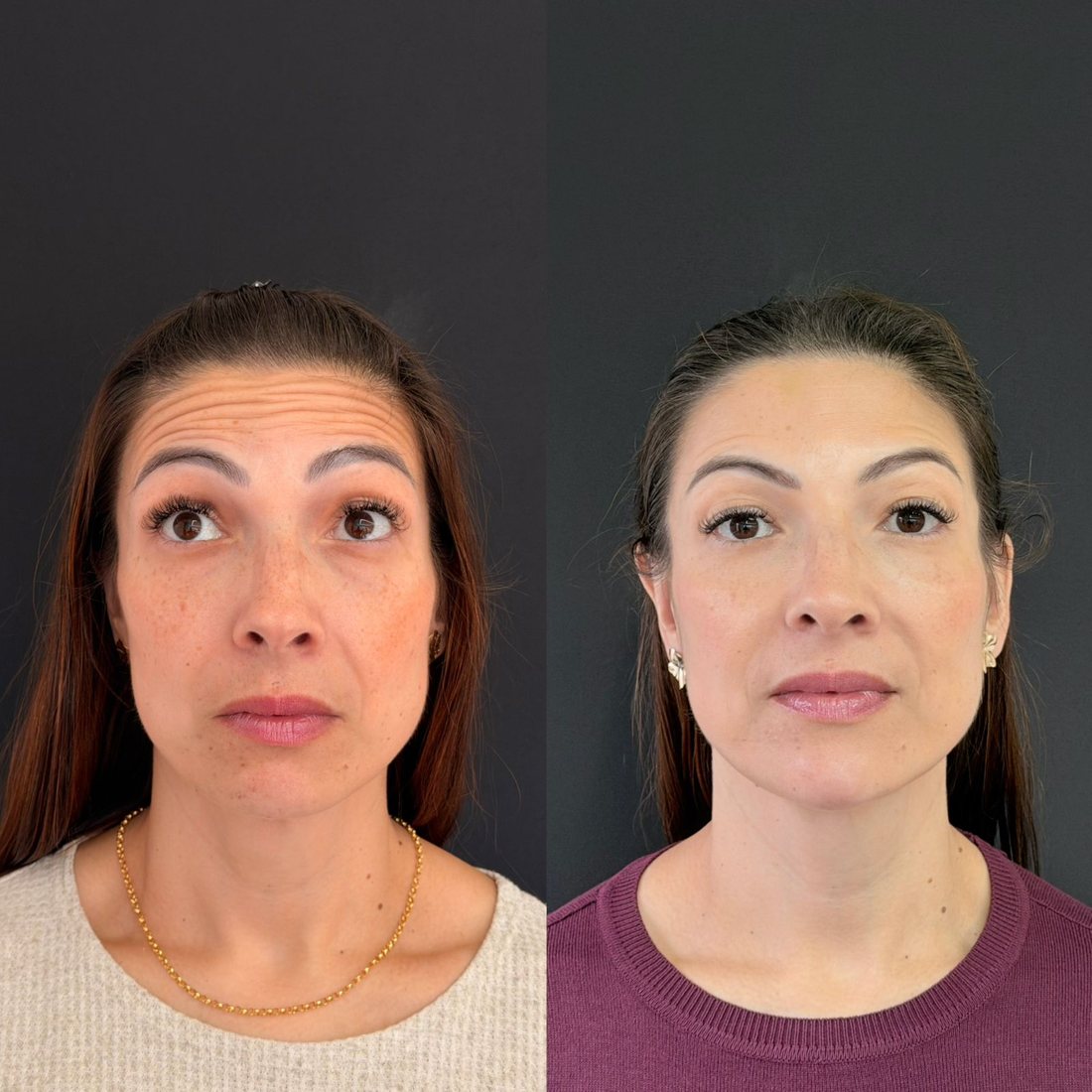 Antes e depois de toxina botulínica